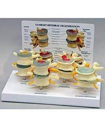 Four Stage Degenerative Lumbar Model
